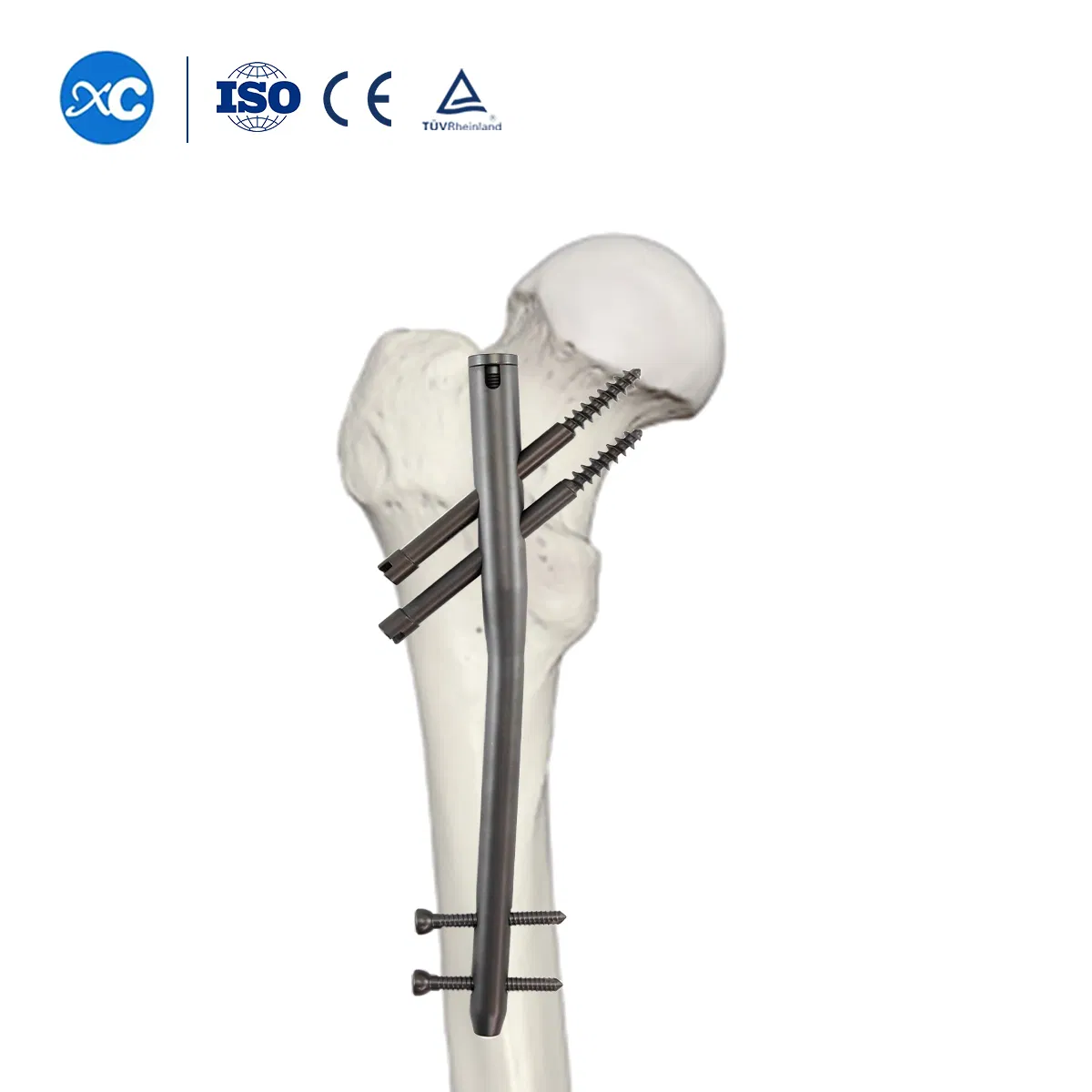 Femur Reconstruction Gamma Intramedullary Interlocking Nails for Bone Fixation Surgery