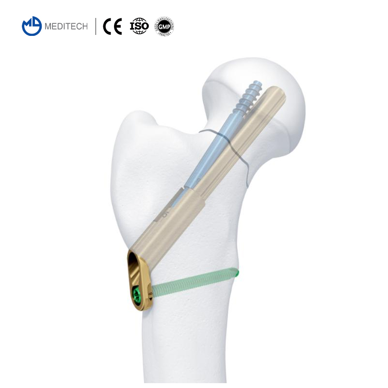 Orthopedic Locking Plates and Screws Femoral Neck Dynamic Cross Screw System