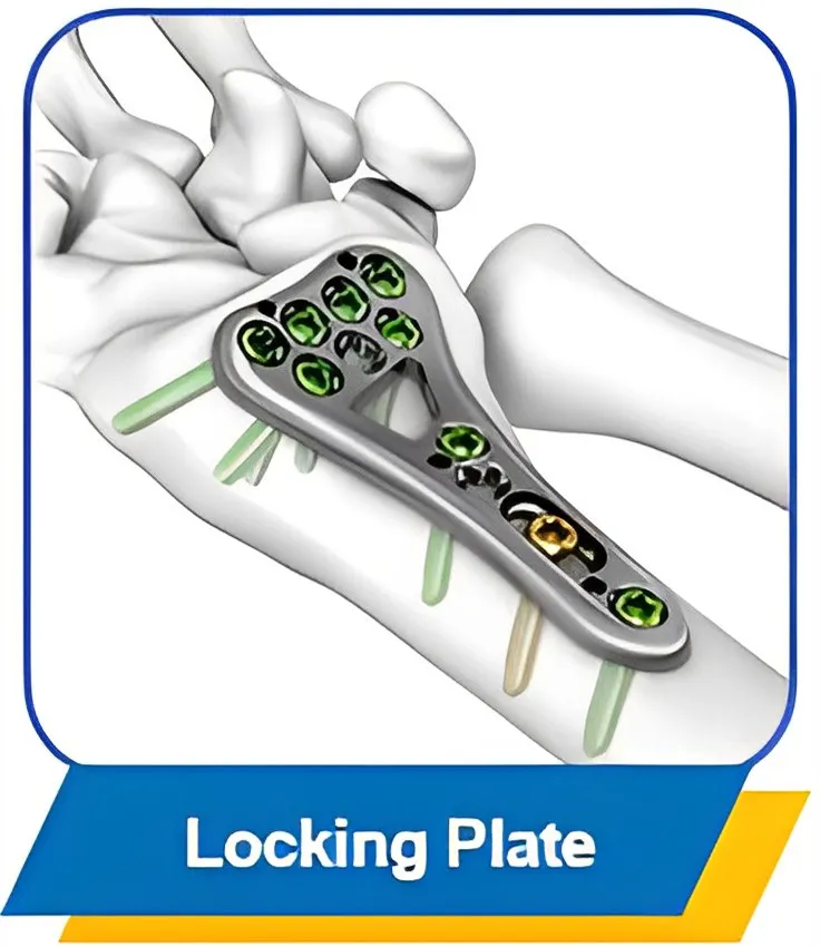 Locking Plate