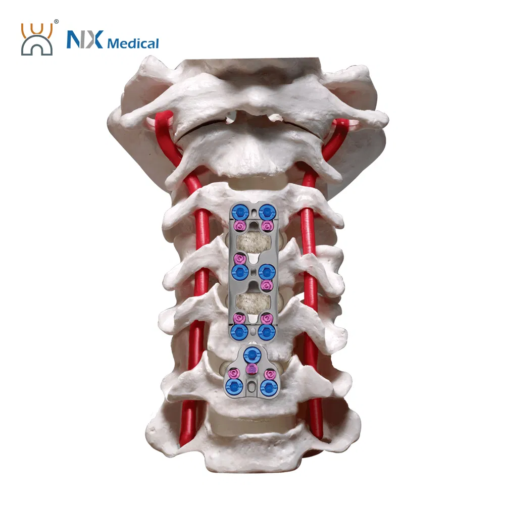 Nx Medical Anterior Cervical Plate System Spine Internal Fixation Titanium OEM ODM