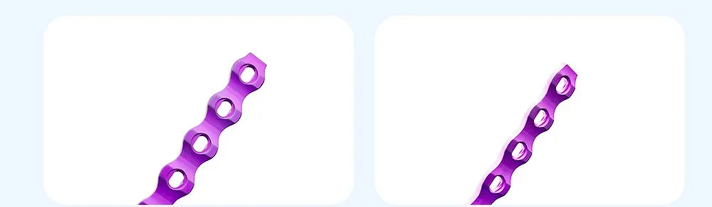 Locking Plate Fixation Effect