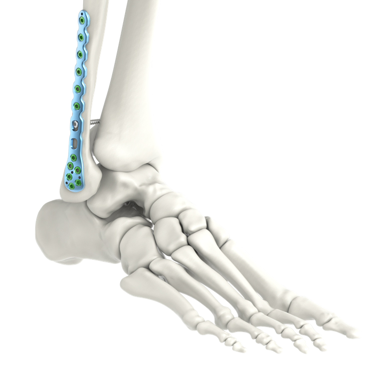 High Quality Pure Titanium Intramedullary Nail System Lower Extremity Fibula