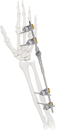 Stainless Steel Humeral Shaft Fixation System