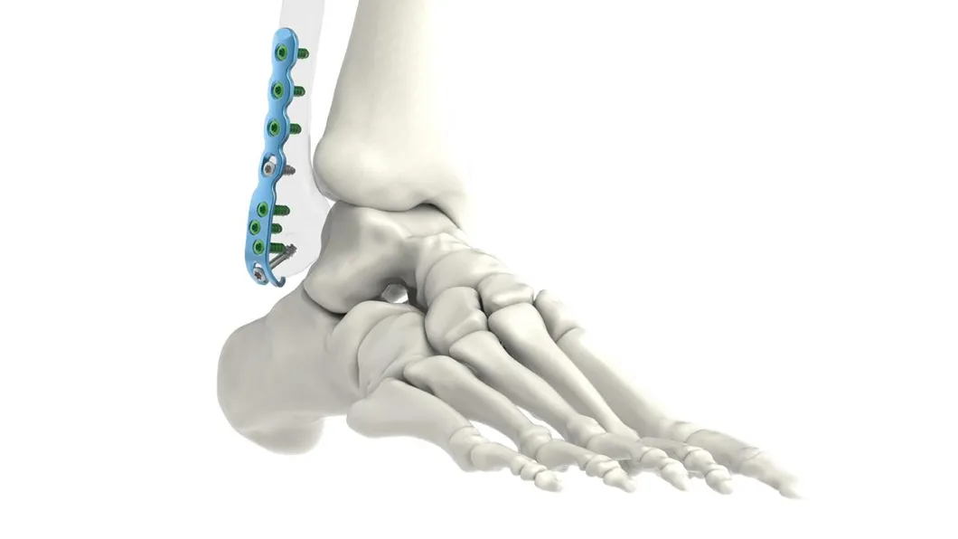 Intramedullary Nail System 1