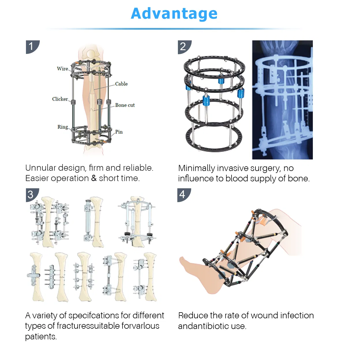 Hot Selling Othropedics Surgery Bone Correction Fracture Surgery External Fixation System