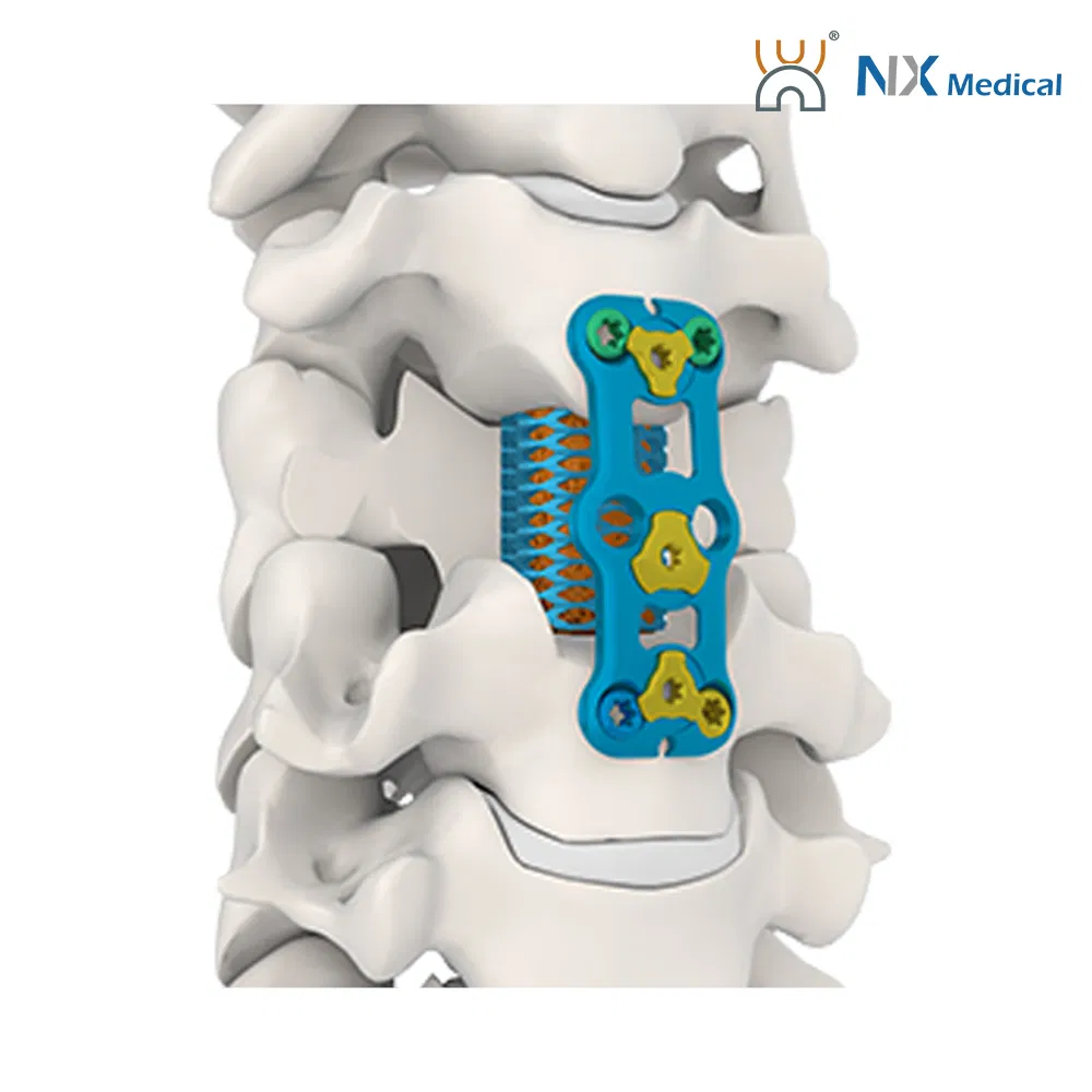 Nx Medical Anterior Cervical Plate System Spine Internal Fixation Titanium Minimum Invasive