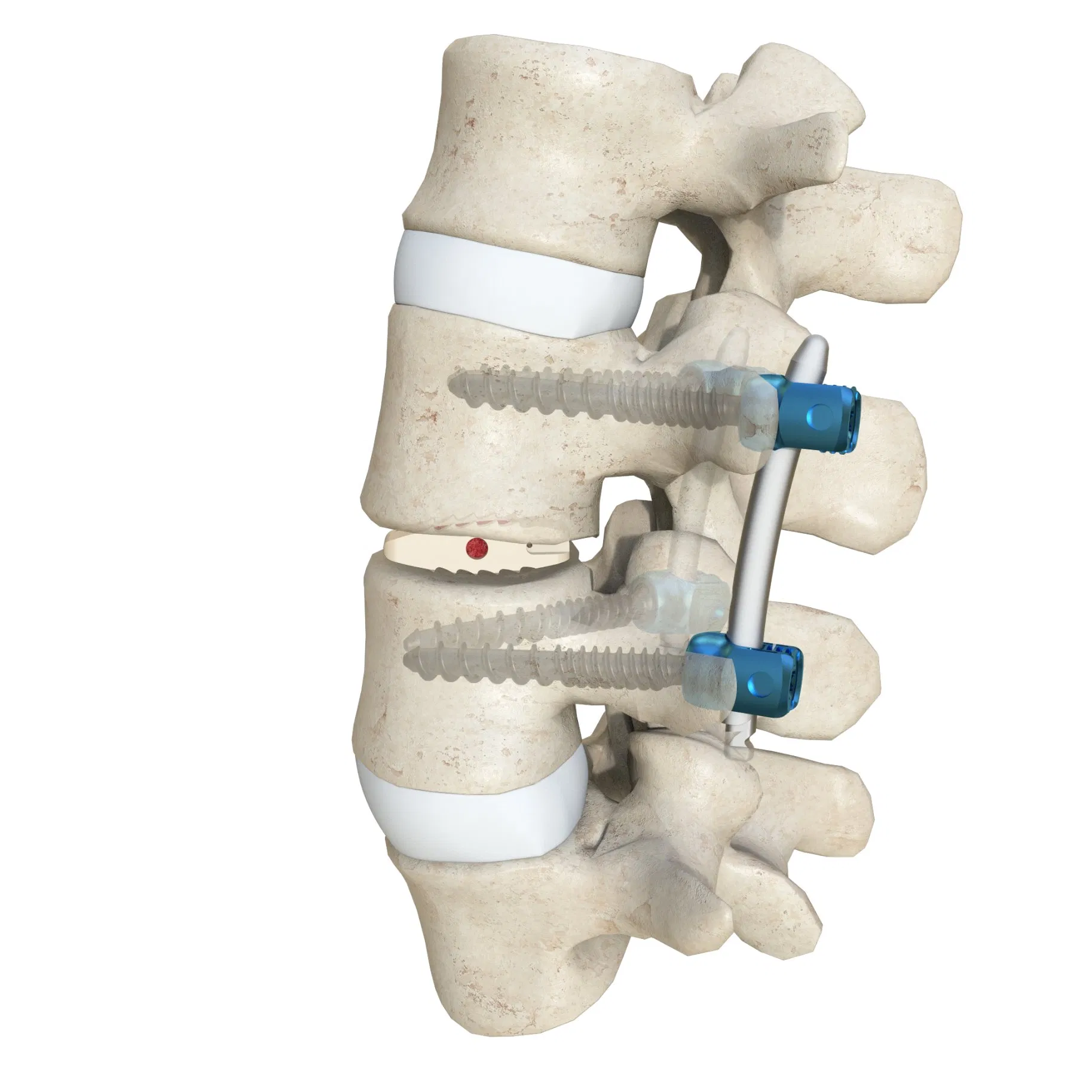 Kidney-Shaped Interbody Fusion Cage for Lumbar Spine