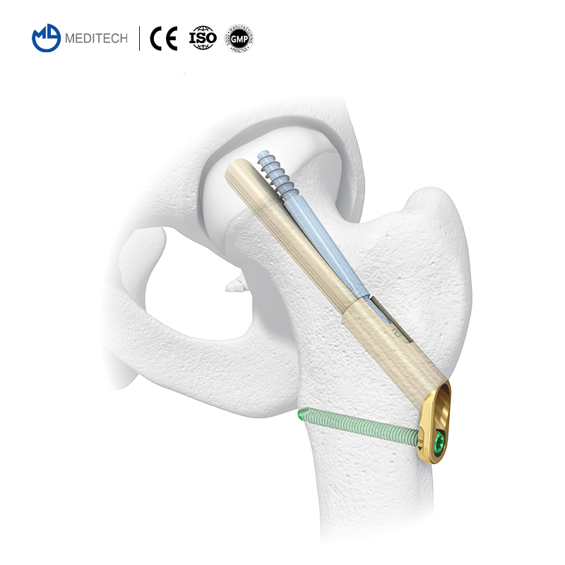 Orthopedic Locking Plates and Screws Femoral Neck Dynamic Cross Screw System