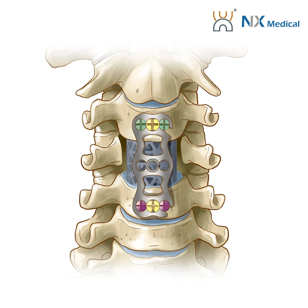 Nx Medical Anterior Cervical Plate System Spine Internal Fixation Titanium China Factory
