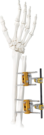 Stainless Steel Humeral Shaft Fixation System