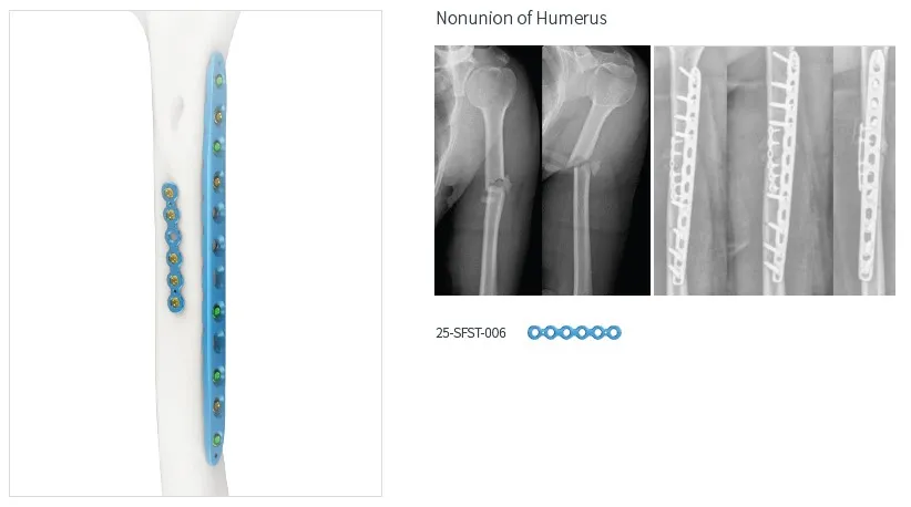 Trauma Plate System 6
