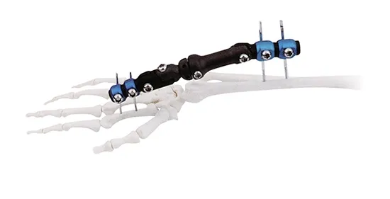 Wrist Fixator Type 3