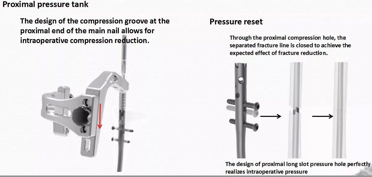 Intramedullary Nail System for Tibia
