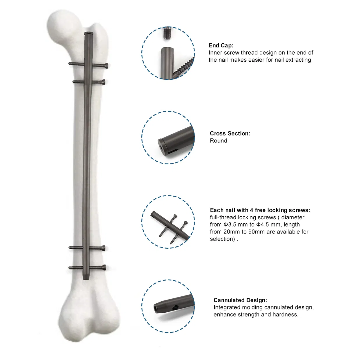 Xc Medico Intramedullary Nail System Reversed Femoral Intramedullary Nail