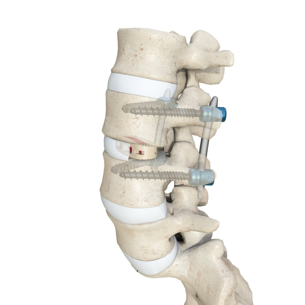 Advanced Oblique Lateral Interbody Fusion Cage for Enhanced Stability