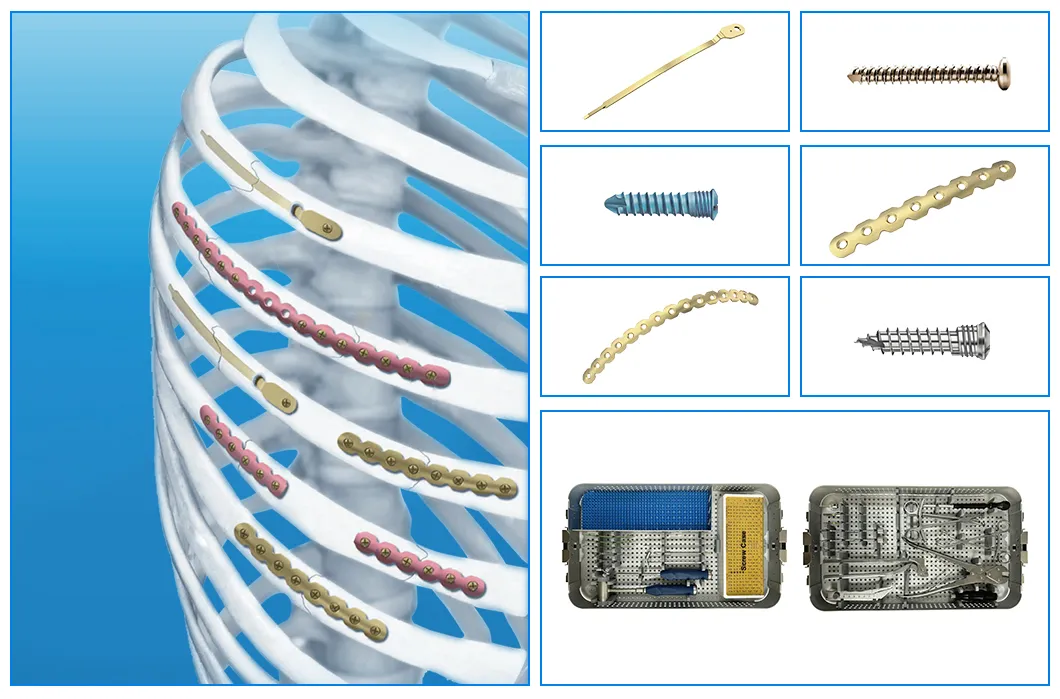 Rib Fixation Details