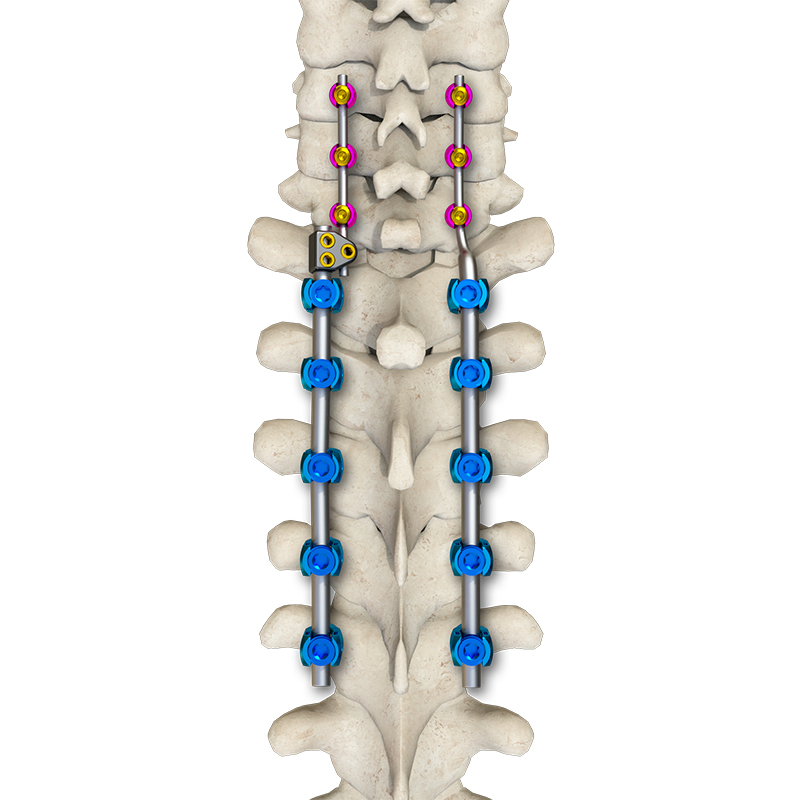 Low-Profile Posterior Occipital-Cervical-Thoracic Spinal System for Spinal Stabilization