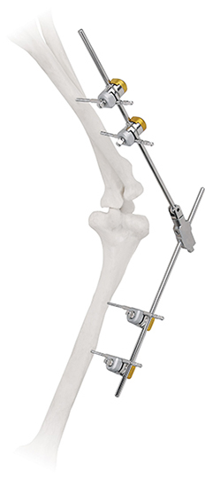Stainless Steel Humeral Shaft Fixation System