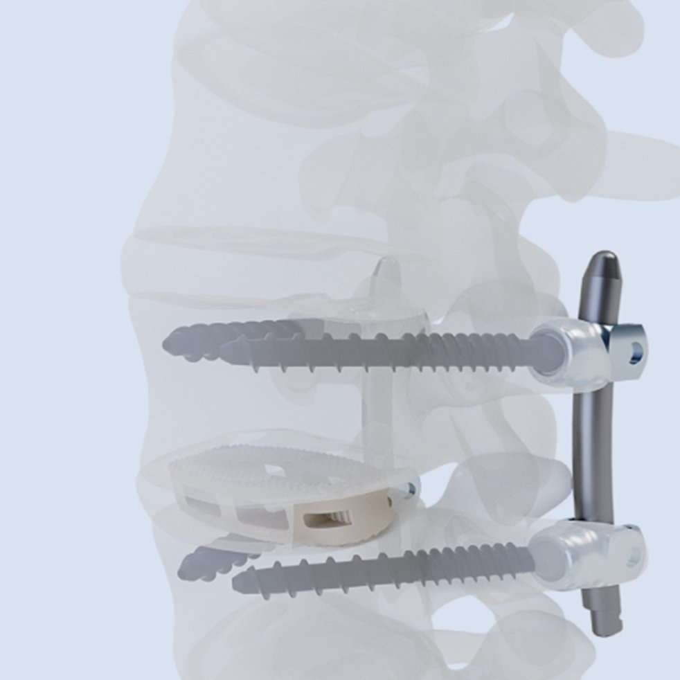 Advanced Oblique Lateral Interbody Fusion Cage for Enhanced Stability
