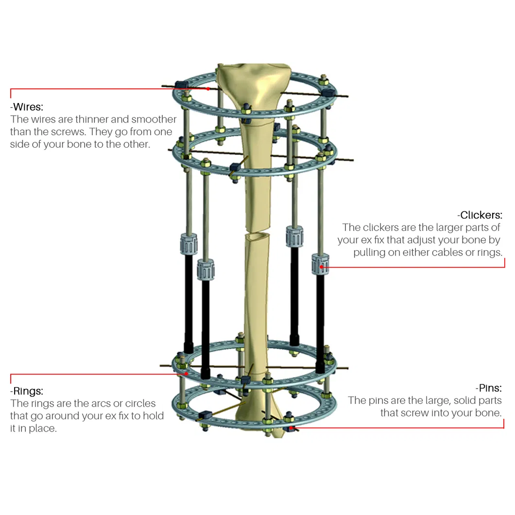 Fracture Surgery System