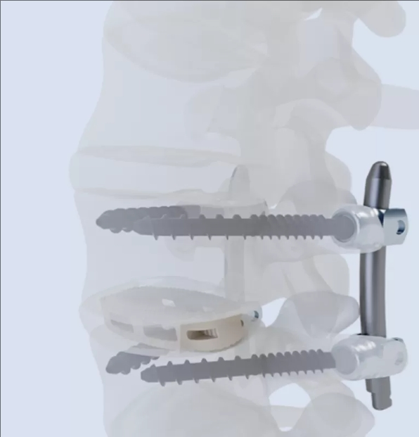 Peek Oblique Lateral Interbody Fusion Cage with High Fusion Rate