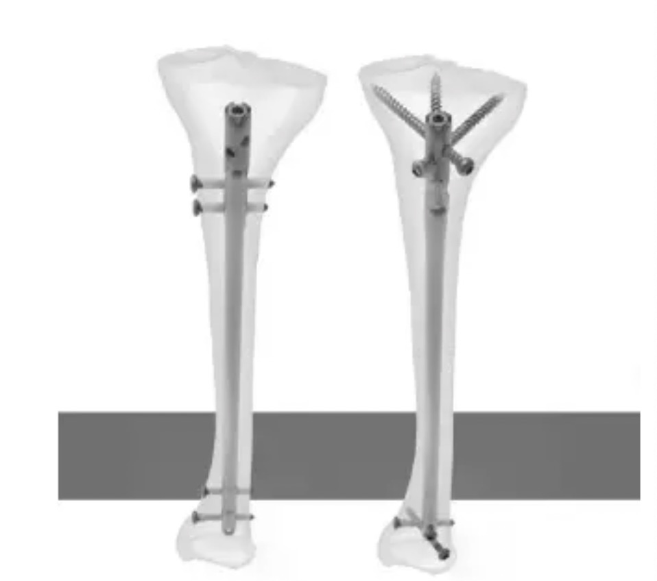 Tibia Intramedullary Nail System for Orthopedic Surgery