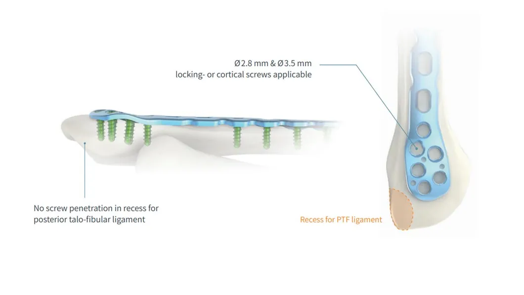 Intramedullary Nail System 4