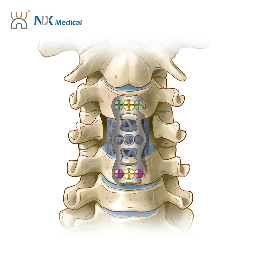 Nx Medical Anterior Cervical Plate System Spine Internal Fixation Titanium Minimum Invasive