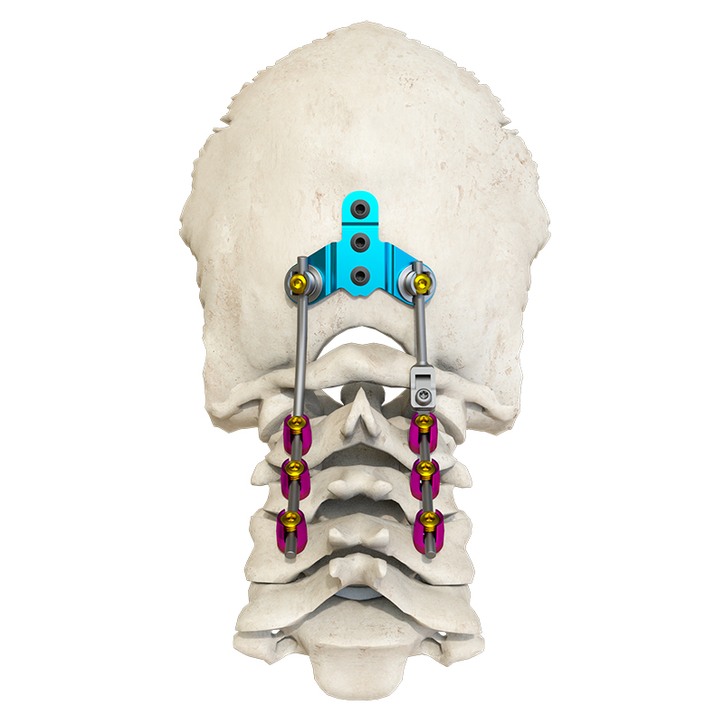 Low-Profile Posterior Occipital-Cervical-Thoracic Spinal System for Spinal Stabilization