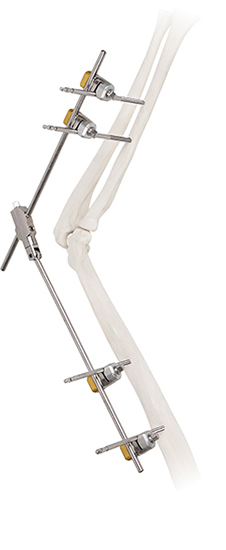 Stainless Steel Humeral Shaft Fixation System