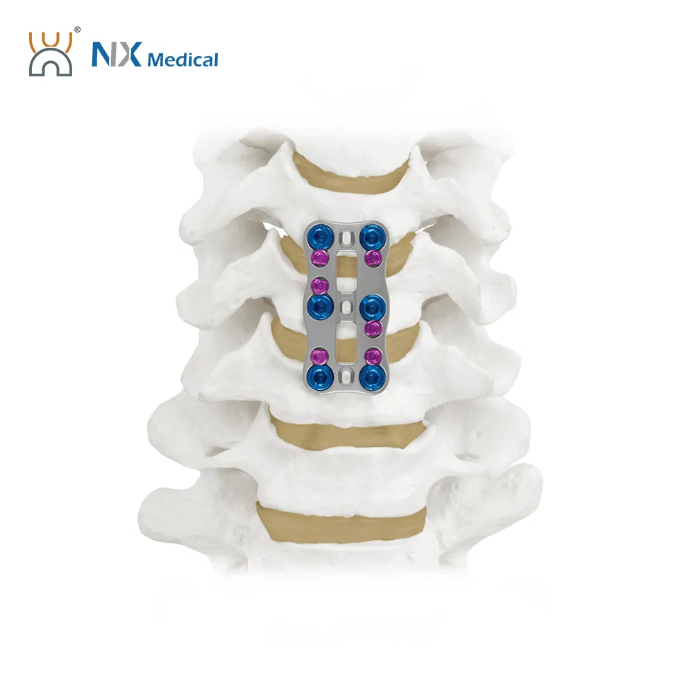 Nx Medical Anterior Cervical Plate System Spine Internal Fixation Titanium Minimum Invasive