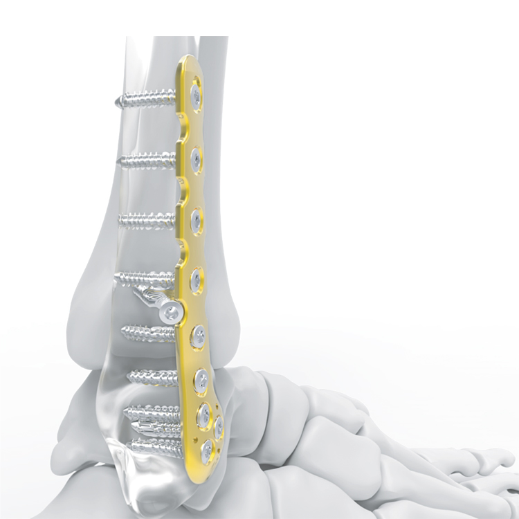 High Quality Pure Titanium Intramedullary Nail System Lower Extremity Fibula