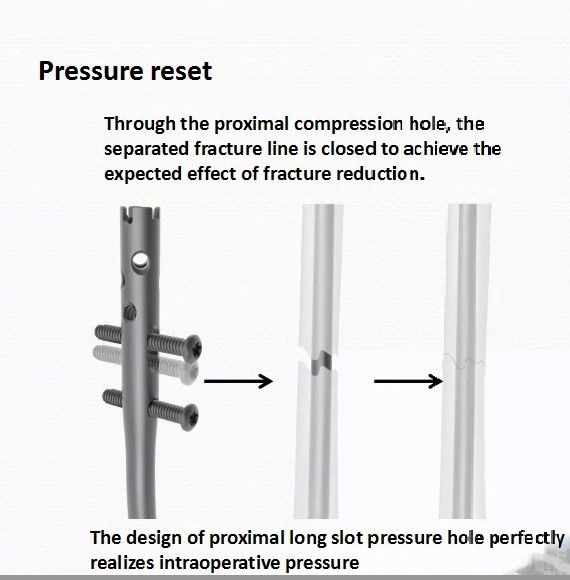 Tibia Intramedullary Nail System for Orthopedic Surgery