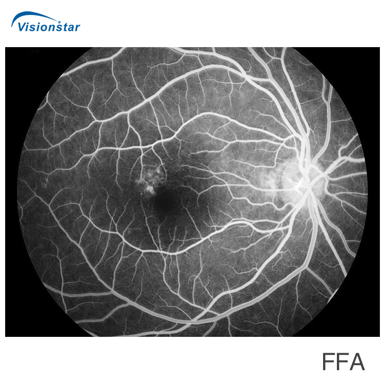 Aps-Cer (Model B) Fundus Camera &amp; Fluorescein Angiography System