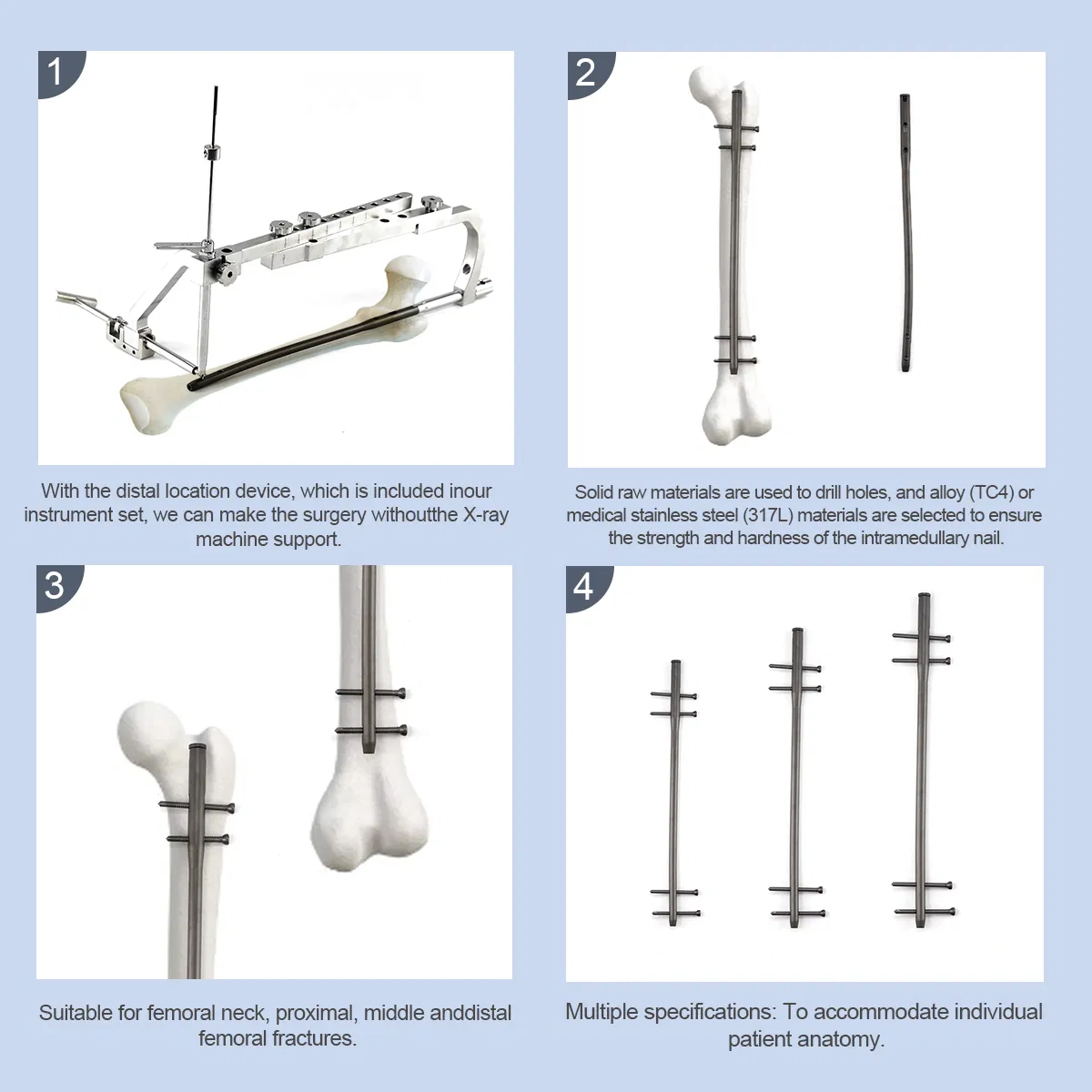 Xc Medico Intramedullary Nail System Reversed Femoral Intramedullary Nail