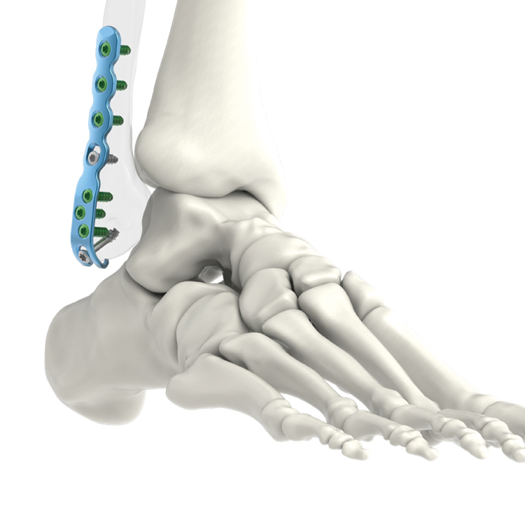 High Quality Pure Titanium Intramedullary Nail System Lower Extremity Fibula