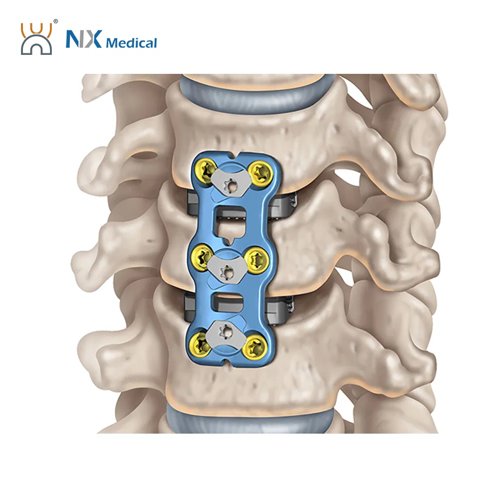 Nx Medical Anterior Cervical Plate System Spine Internal Fixation Titanium China Factory
