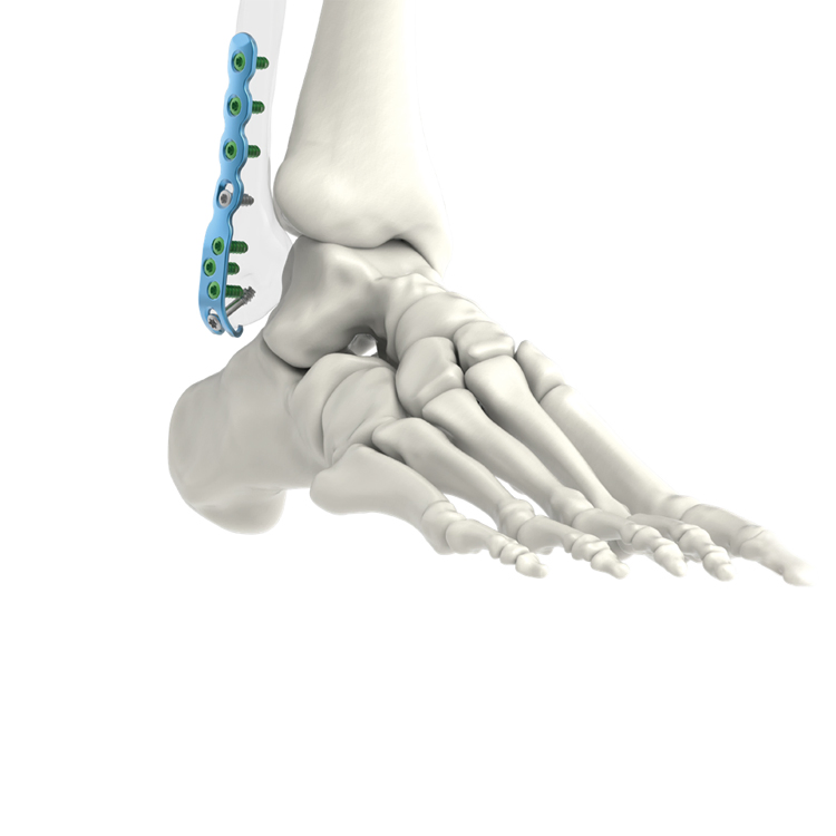 High Quality Pure Titanium Intramedullary Nail System Lower Extremity Fibula