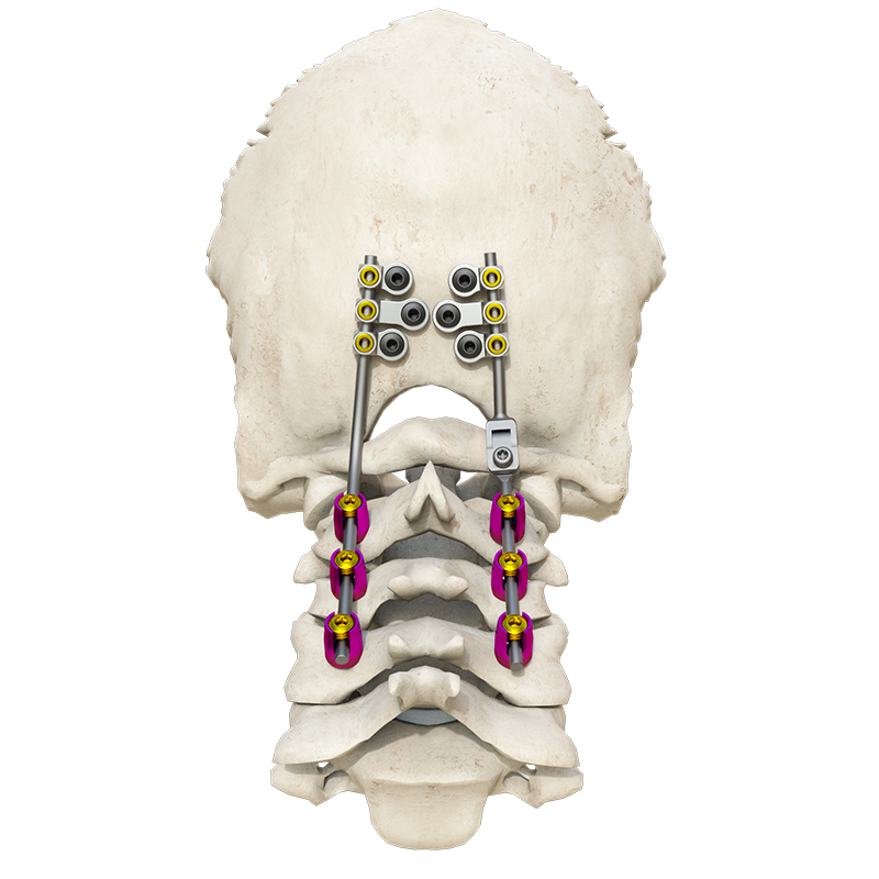 Low-Profile Posterior Occipital-Cervical-Thoracic Spinal System for Spinal Stabilization