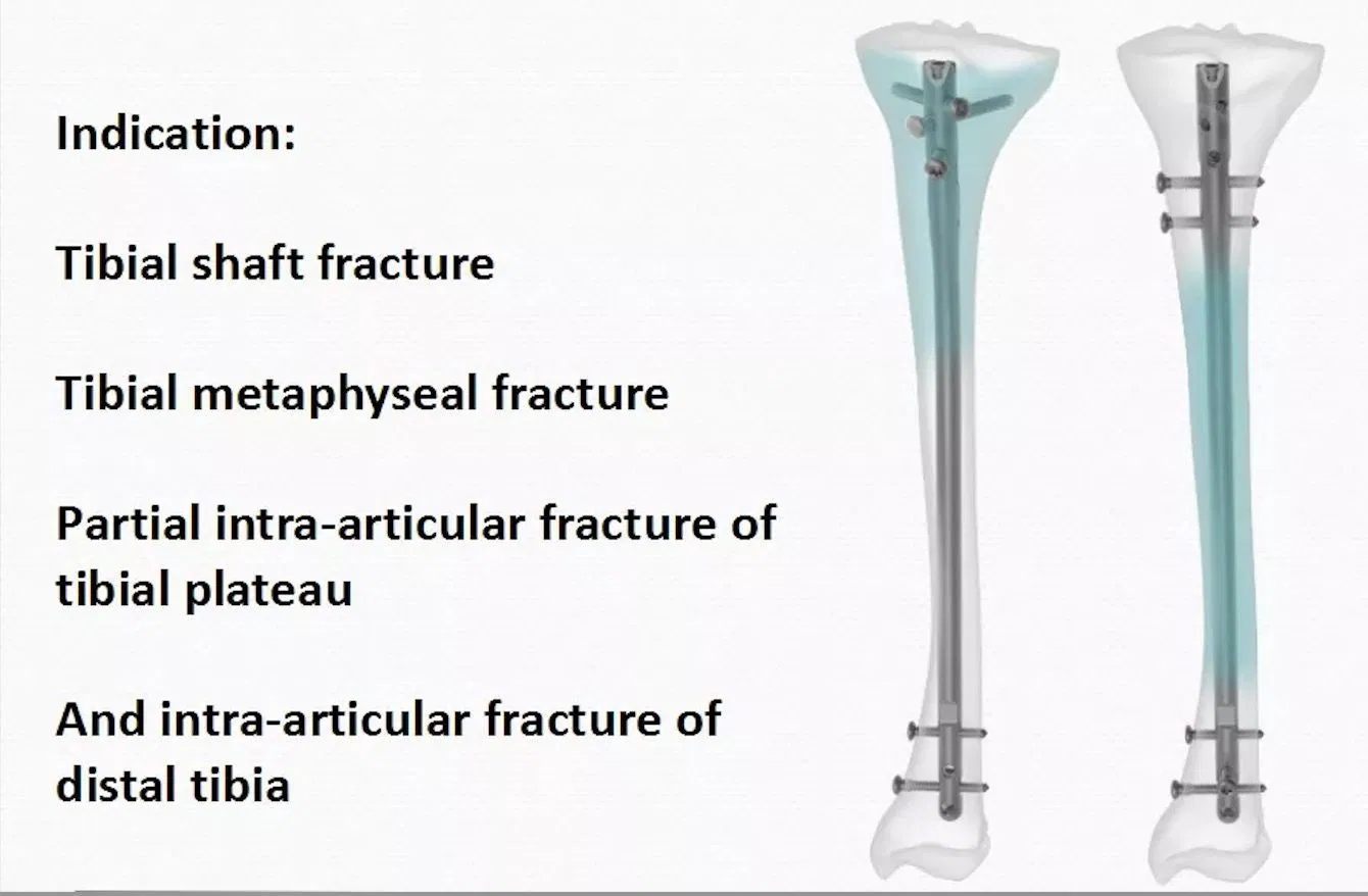 Titaniumtibia Intramedullary/Interlocking Nail System with ISO, CE