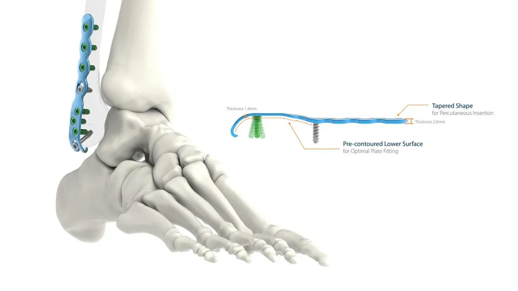 Intramedullary Nail System 5