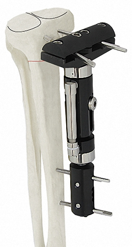 Advanced External Fixator System with Titanium Alloy for Bone Repair