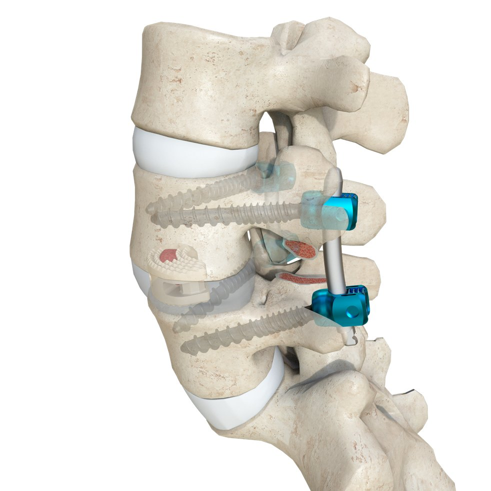 Advanced Lumbar Fusion Cage Mimicking Cortical Bone Strength
