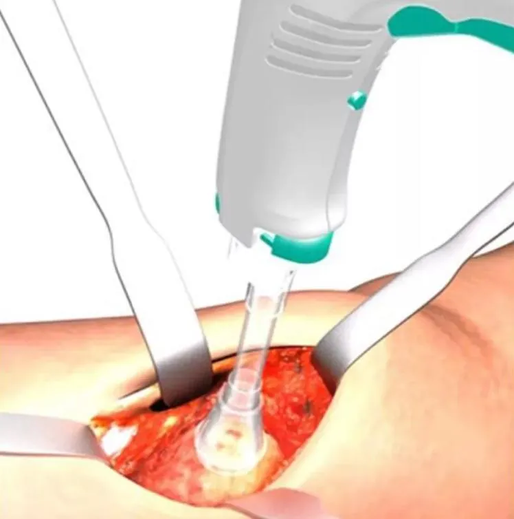 Disposable Pulse Lavage System