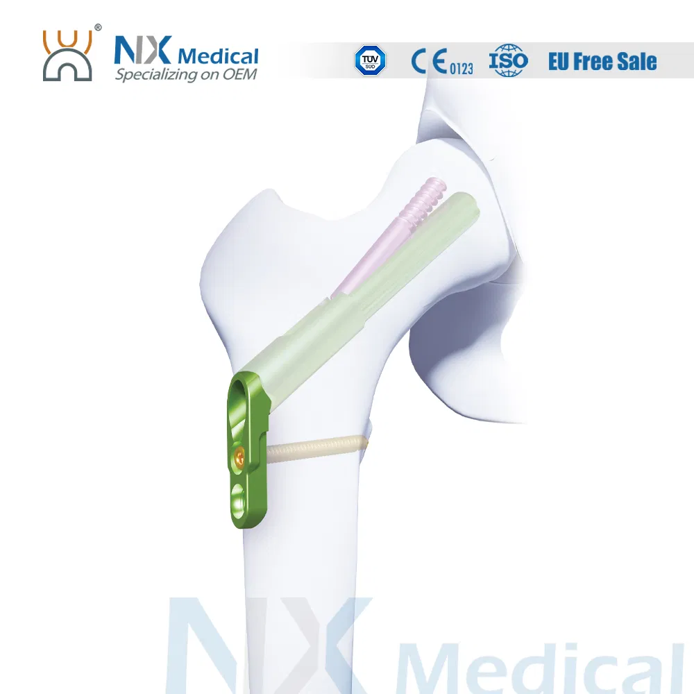 Nx Medical Titanium Locking Femoral Neck System for Trauma Fixation