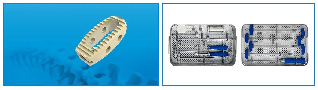Lumbar Cage Features