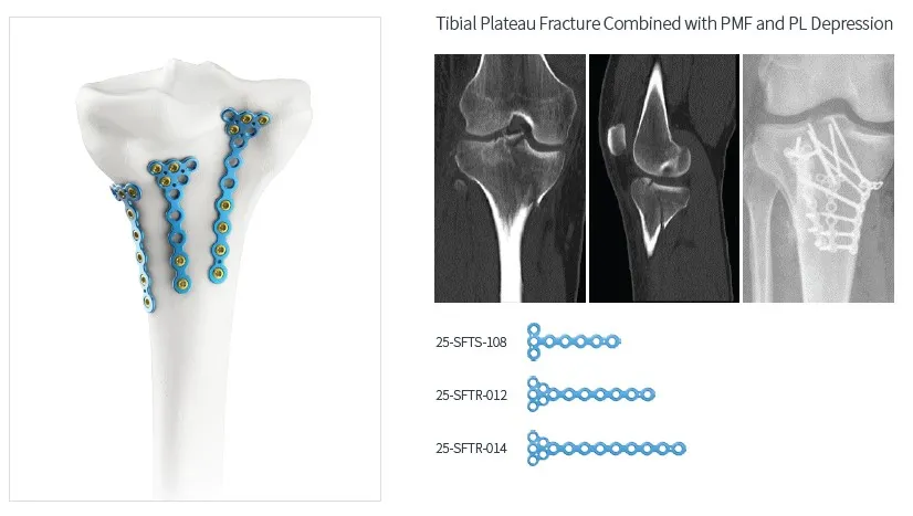 Trauma Plate System 3