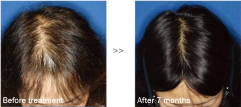 2023anti Hair Loss Care Treatment Aape Efficient Hair Growth Stem Cell Women Men Regrowth Factors for Hair-Loss Prevention, Hair-Repairing and Skin Anti-Wrinkle