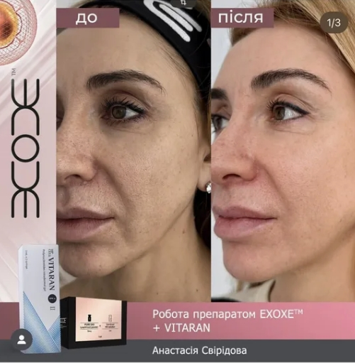 Exoxe Exosome Skin Booster Powder, Anti-Aging Treatment for Wrinkles and Dull Skin Anti-Wrinkle Serum and Facial Care