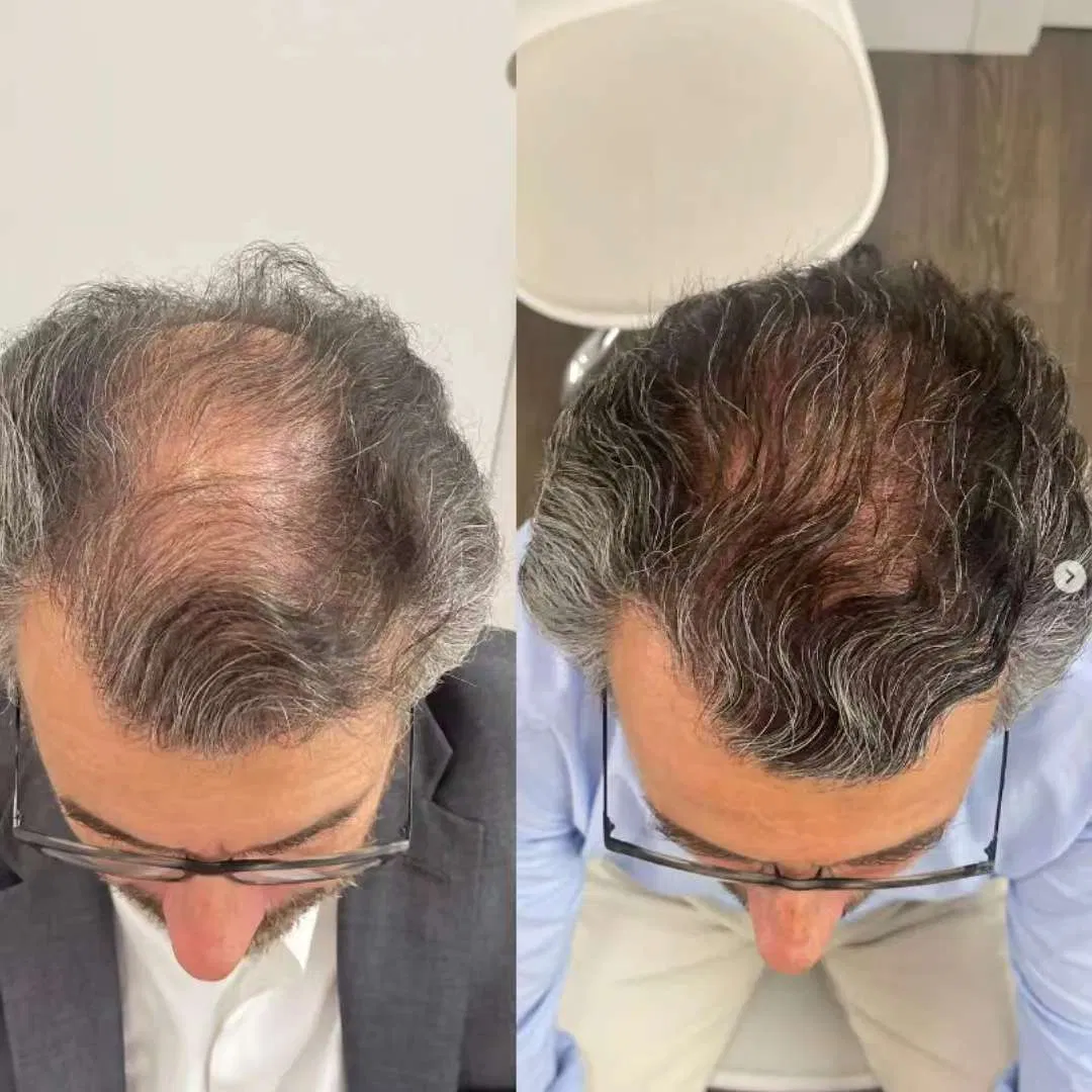 Korea Hair Growth Product Aape Hair Asce Hair Exosome 20mg Scm Haircare Booster Hair Loss Control Scalp Care Asce Hrlv